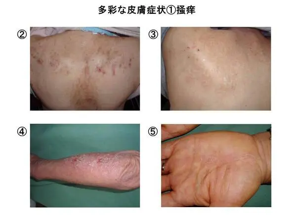 33,100点を超える皮膚炎のストックフォト、写真、そしてロイヤリティフリーの画像 - iStockアトピー, 乾燥肌, かゆい