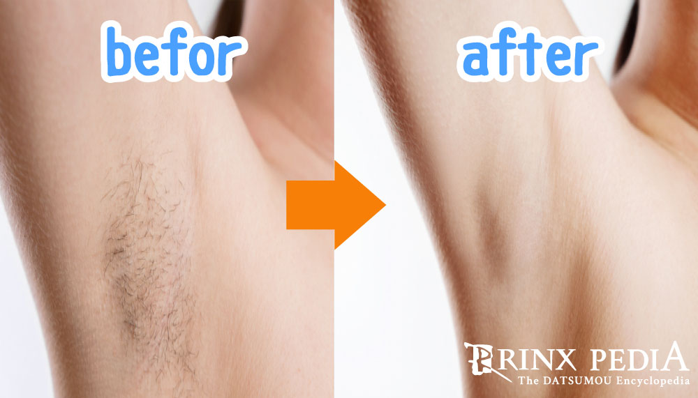 女性の医療脱毛 脇毛をアレキサンドライトレーザーで永久脱毛 症例写真- ヘアケアクリニック 六本木・福岡のAGA治療・注入療法