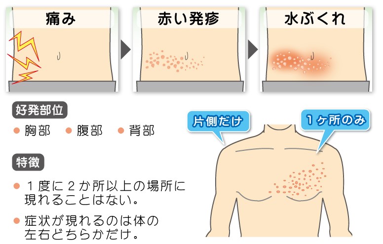 早めの対策 痛みで辛い！帯状疱疹 の原因から症状・ワクチンについて皮膚科医が完全解説医療法人義恵会 公式サイト