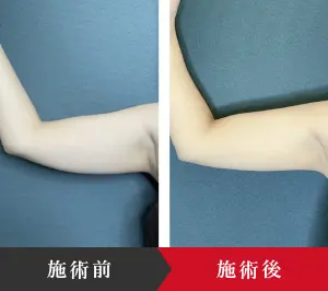 セルライト除去は自分でできるの? 脂肪専門医が原因となくす方法を解説