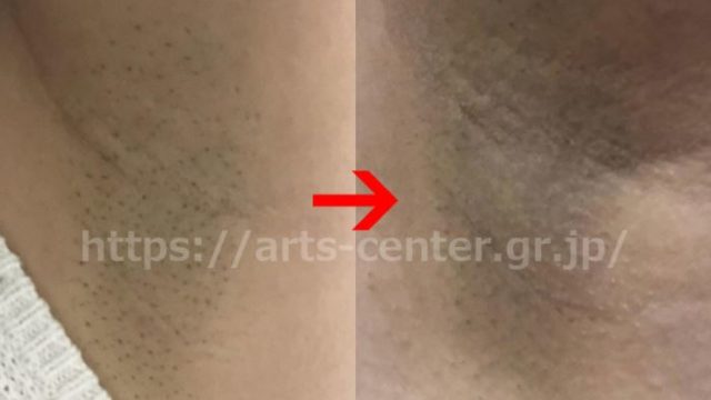 ⏩顔脱毛のコース値段と回数や効果🍀ミュゼプラチナム✨