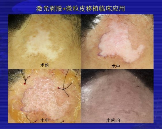 白斑 白なまず と外傷後の色素脱失旭川皮フ形成外科クリニック