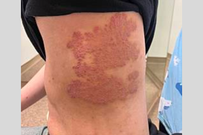 ニキビ、脂漏性皮膚炎、蕁麻疹、：おもにストレスとビタミン不足症状です青山ヒフ科クリニック院長Dr.亀山のオフィシャルブログ