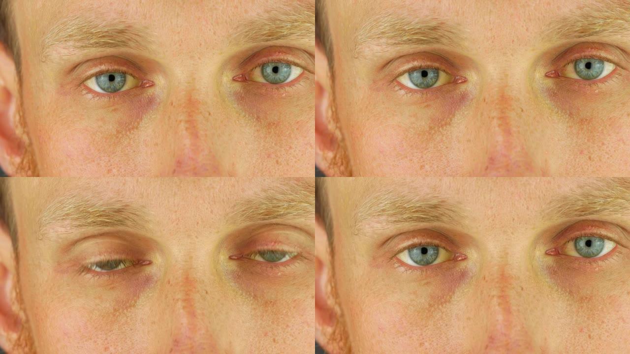 如果你有眼白发黄的现象，请警惕！_眼睛_视力_浓度