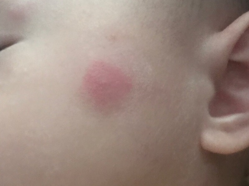 アーサ虫による虫刺されにご注意!!沖縄県公式ホームページ