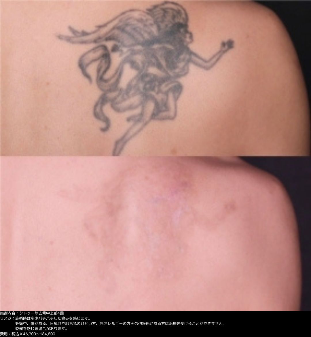 タトゥー除去より綺麗に消える - YouTube