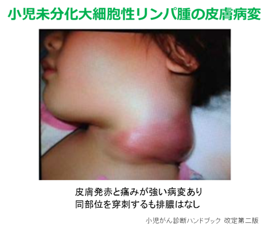 リンパ節腫脹の原因・検査・治療法を新潟市のとがし医院が解説