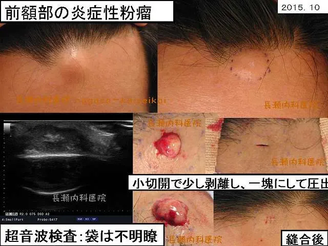 粉瘤クリニックひいらぎ皮膚科形成外科池尻大橋・渋谷・三軒茶屋