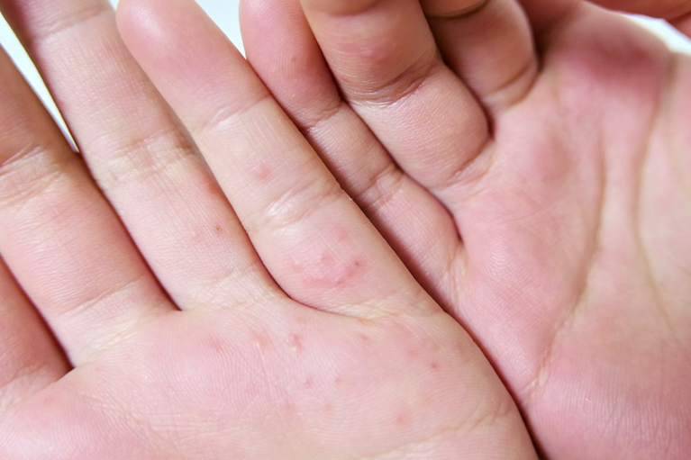 湿疹・皮膚炎』でかゆみが起きる原因は？かゆみを伴う皮膚疾患とその対処法田辺三菱製薬ヒフノコトサイト