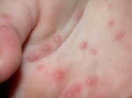 手足口病 小児科一条通病院道北勤医協