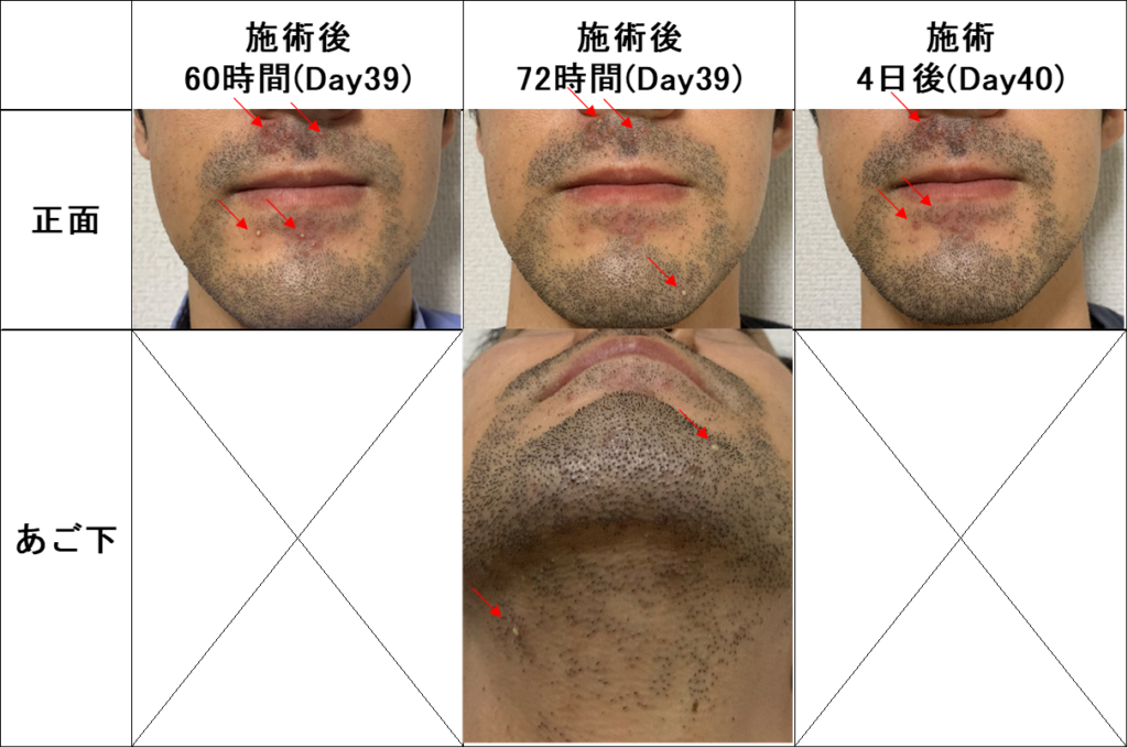 ヒゲ脱毛の経過についてメンズ脱毛サロンRASHINDO横浜鶴見店メンズ脱毛サロンRASHINDO横浜鶴見店
