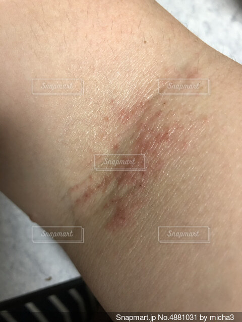 あせも 汗疹横浜市青葉区にある内科、小児科、家庭医療-ファミリークリニックあざみ野