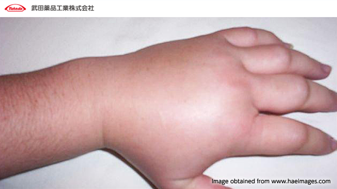 Derma Bridge 遺伝性血管性浮腫 HAEマルホ 医療関係者向けサイト