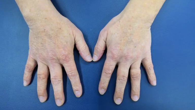 手の甲のシミの原因って？ - 手肌ラボ