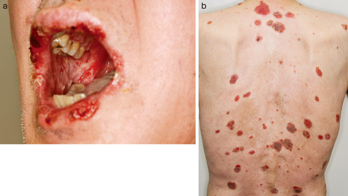 保存的治療で治癒した糖尿病足，3度熱傷の一例
