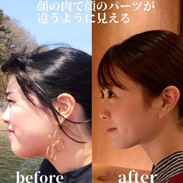 頬肉を落とす方法7選！効果的なトレーニングやマッサージは？メソセラピー・痩身なら城本クリニック