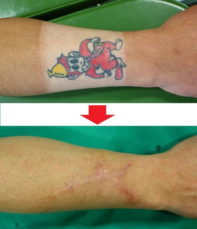 入れ墨の除去の料金や施術内容静岡の美容皮膚科・美容外科ならスキンクリニック藤枝院 掛川院 公式