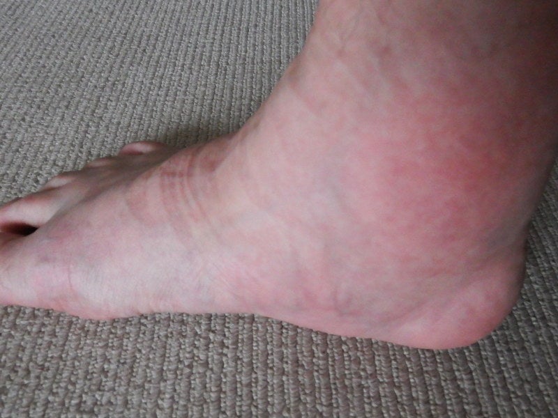 痛風伝統鍼灸 楓庵