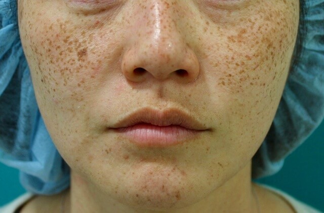 なぜ 外国人はそばかすを気にしない4つの理由！すっぴんの印象は？白人は化粧しすぎない？日本人は珍しい？Abroader アブローダー