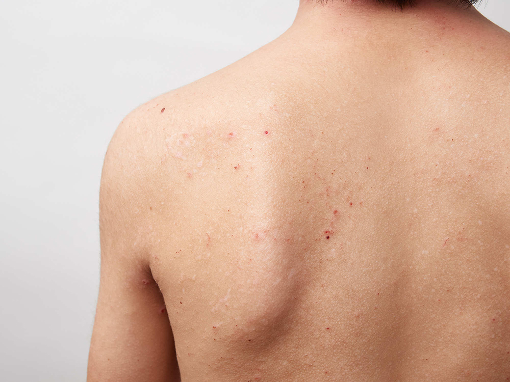 背中ニキビの原因とおすすめの治し方・予防法について美容皮膚科タカミクリニック 東京 表参道