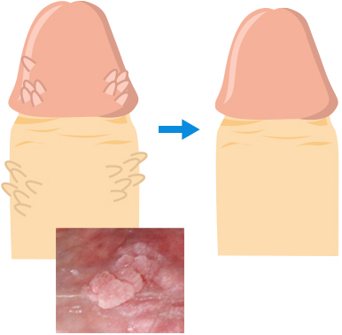 近年治療が進歩した尖圭コンジローマ」医療法人社団 予防会 - コラム・ニュースページ