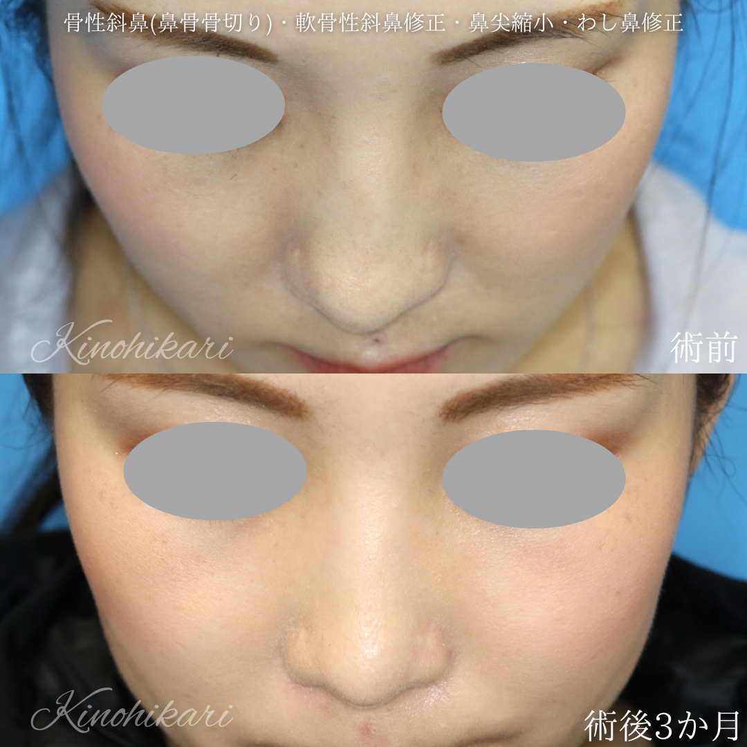 斜鼻修正の料金や手術方法 新宿と池袋の美容整形は東京シンデレラ美容外科