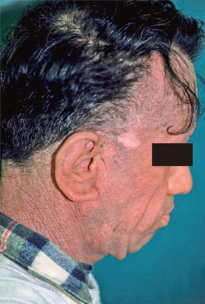 それ毛孔性苔癬かも埼玉県越谷市 毛穴ケア専門サロン ザエバーグリーン