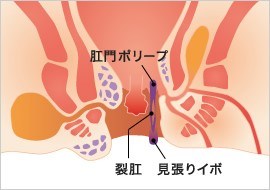 いぼ痔でも切れ痔でもない「あな痔」とは何か？：できやすい人と予防法についてMEDLEYニュース
