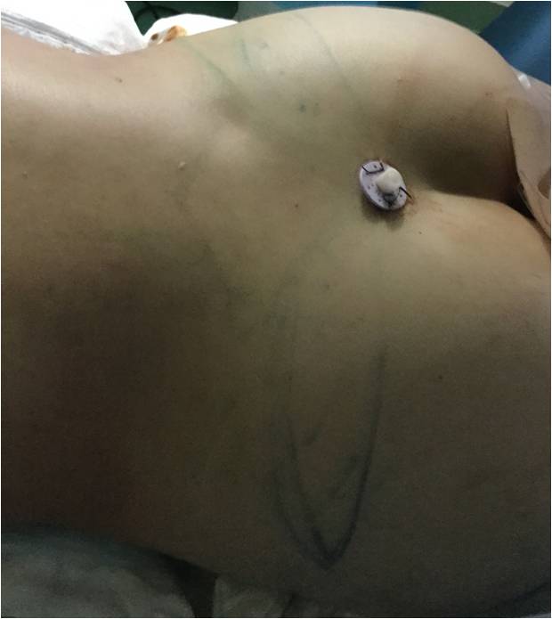 ヴィーナスのえくぼ 作ります。THE CLINIC 志田雅明 オフィシャルブログ