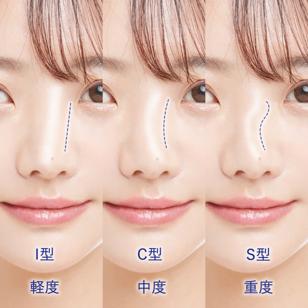 曲がった鼻を美しく整える手術・斜鼻修正：美容外科 高須クリニック