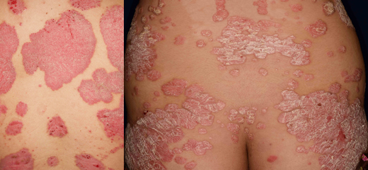 乾癬 ひびきの皮ふ科 北九州市八幡西区学研都市ひびきのにある皮膚科 光線治療対応