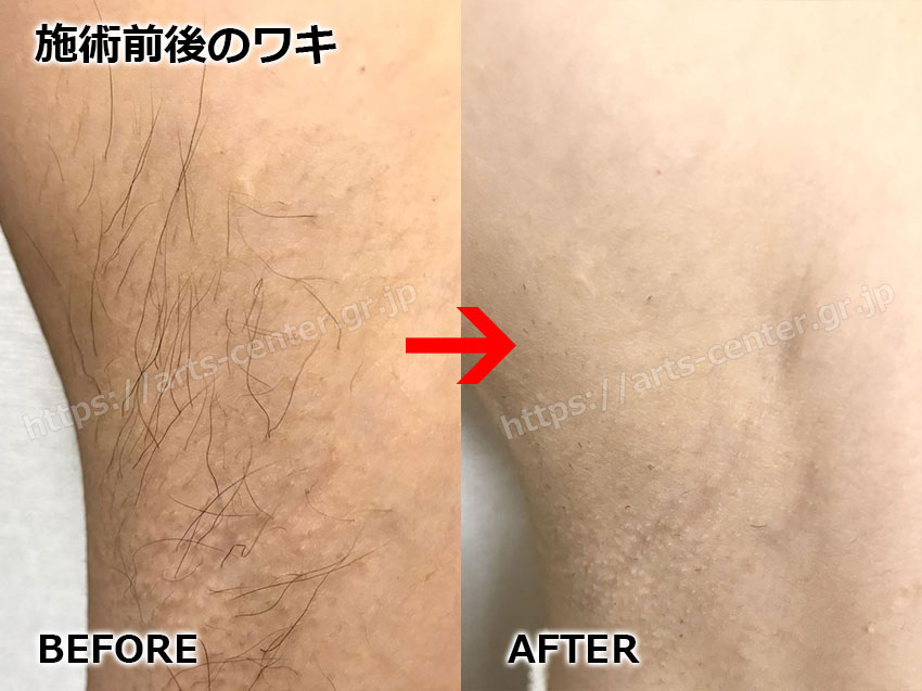 メンズ脇脱毛5回目。 今回脱毛する前の脇の毛量でもかなり減ったし、 あのくらいなら、脇毛を残したい方でも。そこまでボサボサに見えない量にはなってぃましたが。 今回もきっちり全部取ります😊 なぜなら、脇は、匂いがこもりやすいからです😅脇で、汗が意外とズット