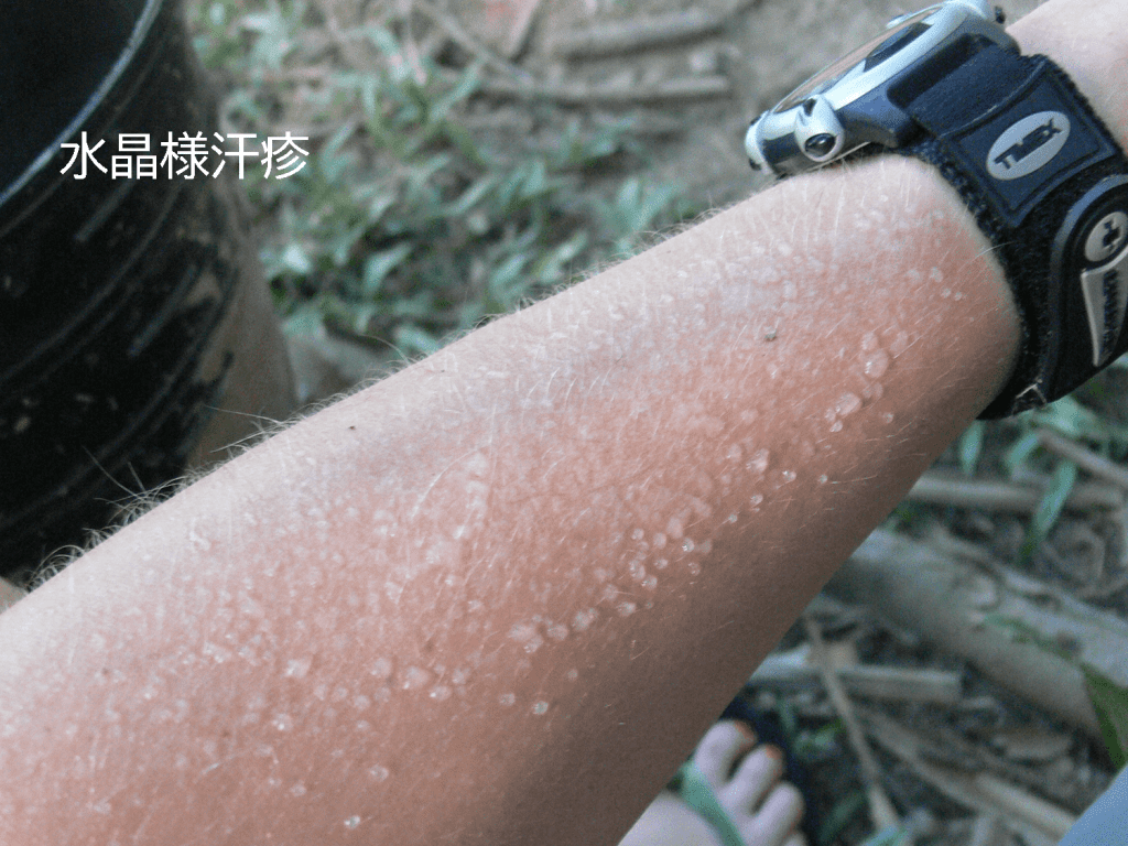 大人あせもの写真・画像素材-Snapmart スナップマート