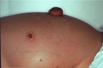 腹水ぬけた！ネイルサロンKOH&SACHIのブログ☆ネフローゼになっちゃった