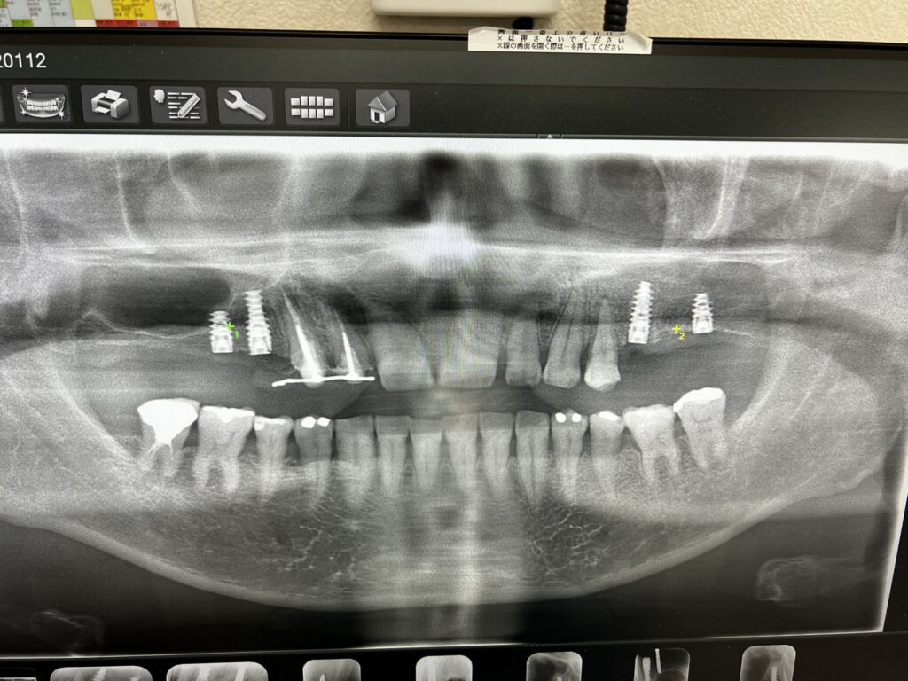 入れ歯治療玉出駅 住之江区 の歯医者「たなべ歯科医院」