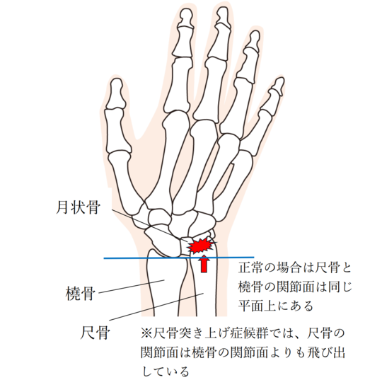 TFCC 三角繊維軟骨複合体 損傷・尺骨突き上げ症候群とはメディカルノート