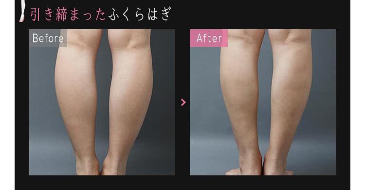 足首・ふくらはぎを細くしたい！おすすめの美容施術は？ 公式 オザキクリニック 新宿・目黒祐天寺・羽村