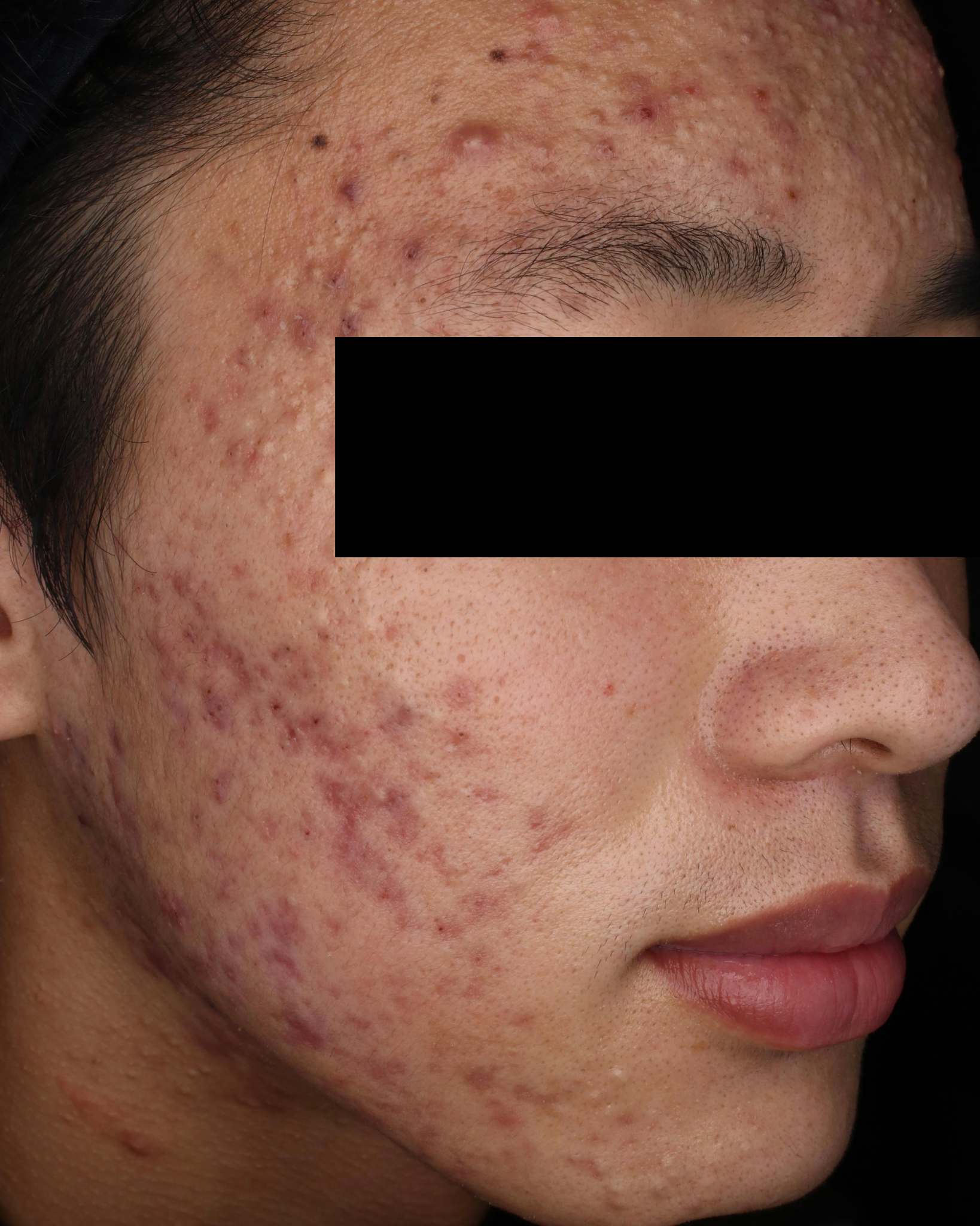 汚い画像すみません。 - ２０歳の男です。昨年あたりから胸の間と背中にニキビが- Yahoo!知恵袋