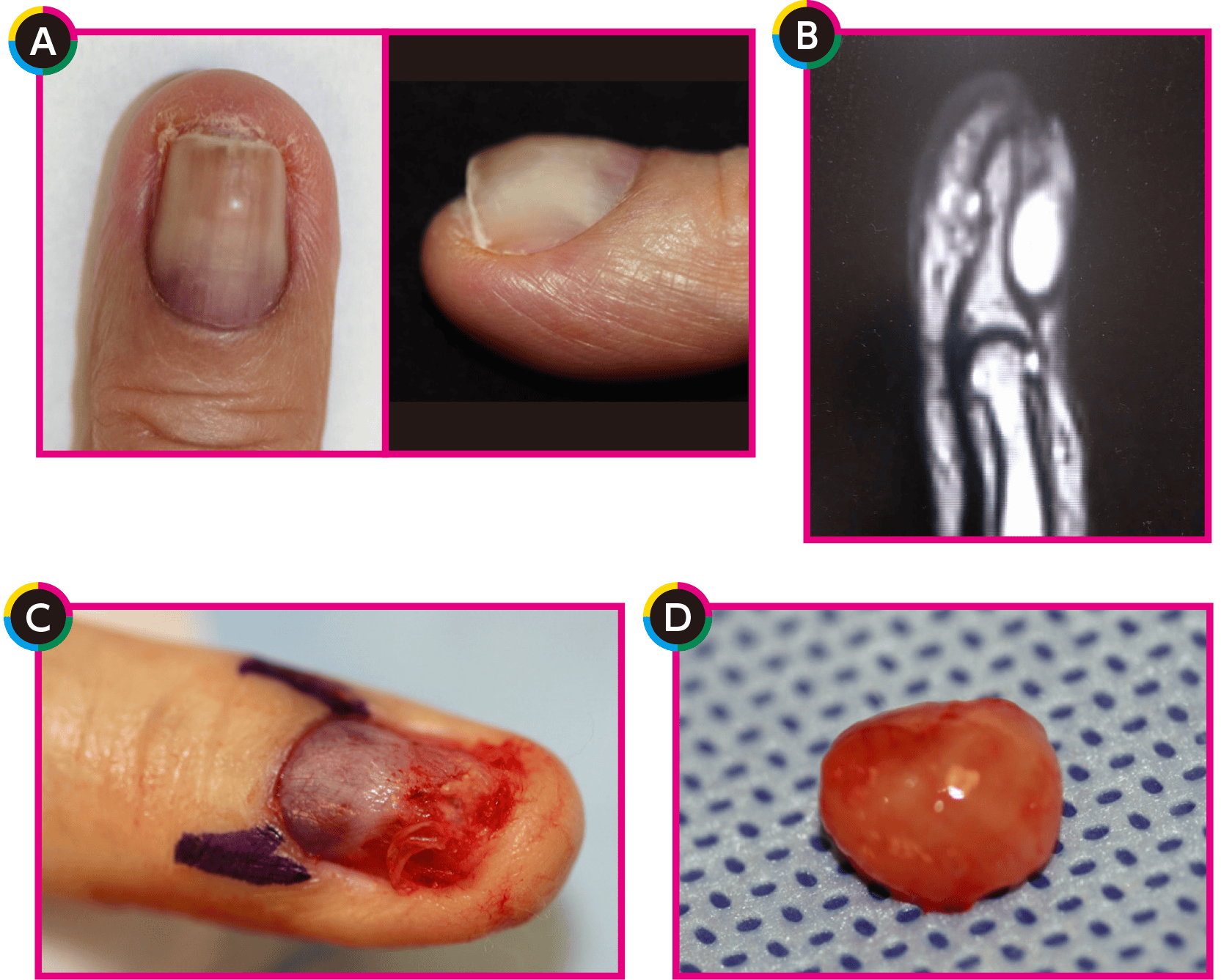 爪の病気埼玉県皮膚科医会