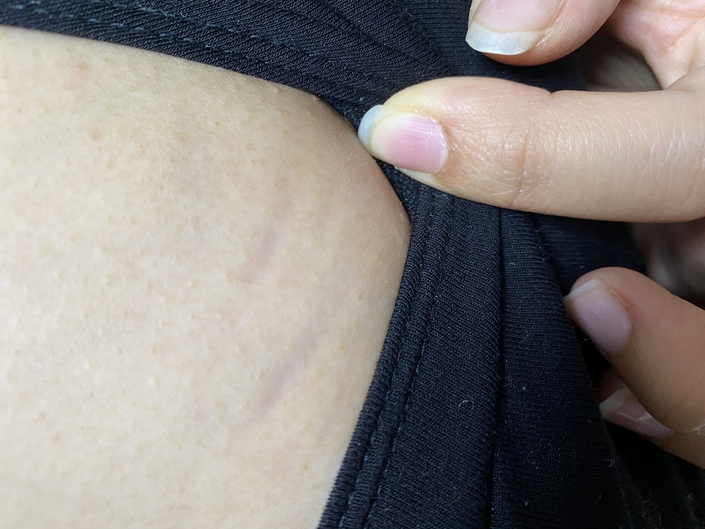 38週に入ります。妊娠線ひどいですか？ - そのうち白くなるとは聞きますが、画- Yahoo!知恵袋