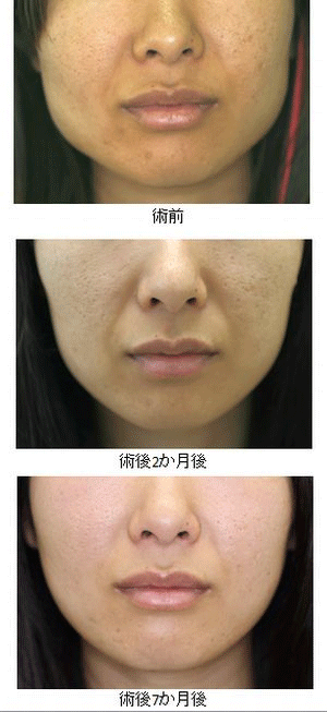 症例写真 エラのボトックス小顔注射美容整形はTCB東京中央美容外科