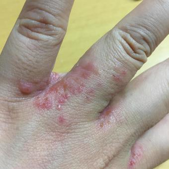 アルコール消毒による手荒れの原因と対策は？おすすめの保湿方法