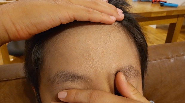 子どもの目の周りの湿疹赤いぶつぶつの原因。病院は何科？kosodate LIFE 子育てライフ