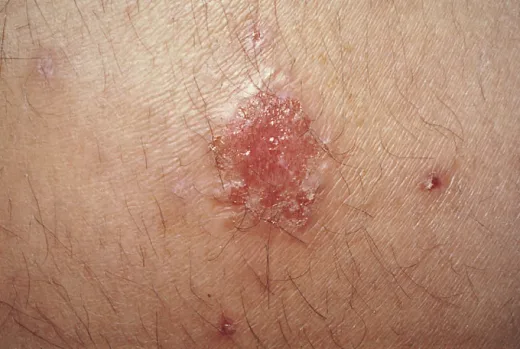 主な皮膚の病気一覧・症例画像・症状・原因・治療法 医師が解説皮膚・爪・髪の病気All About