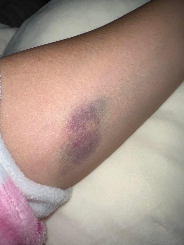 涙袋ヒアルロン酸の失敗を防ぐための当院独自の術法 - 池袋の美容皮膚科・美容外科なら「みずほクリニック」