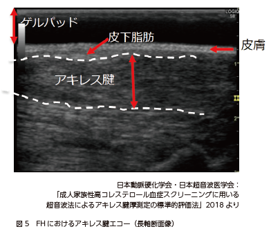 脂質異常症の初期症状とは？コレステロールが高いとどうなる？特徴を医師が徹底解説。 - オンライン診療ならウチカラクリニック