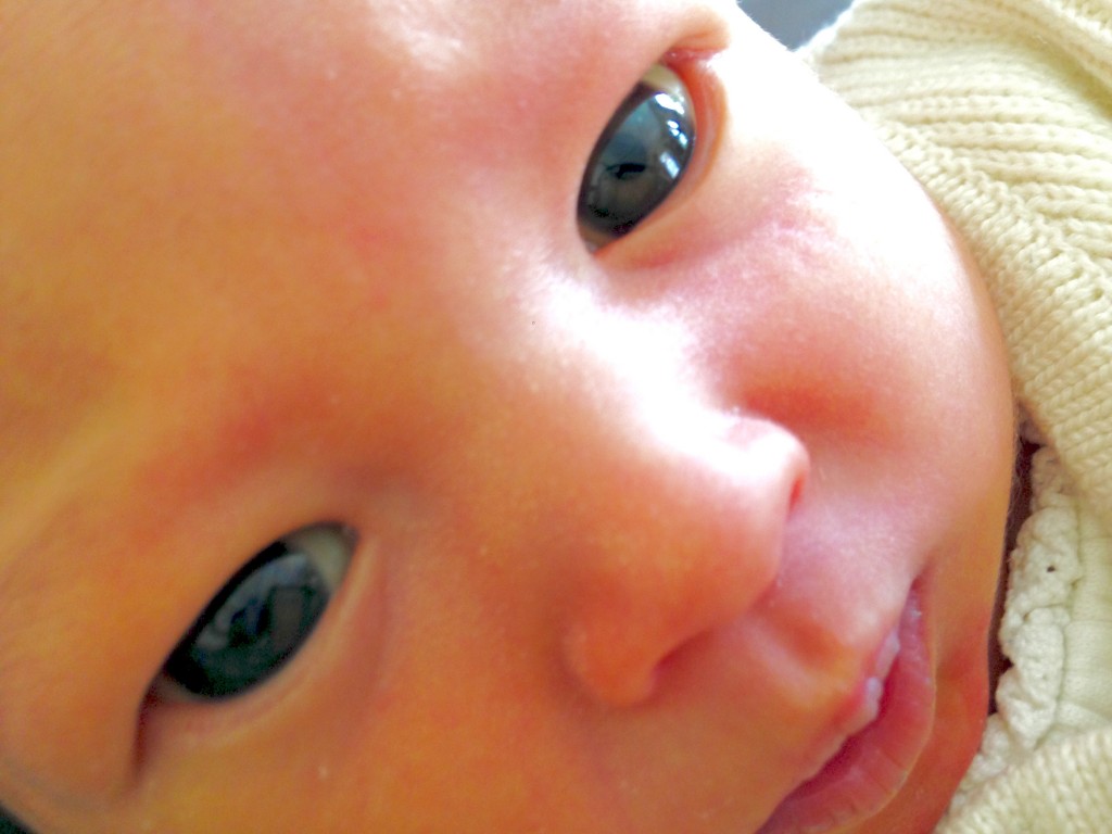 新生児黄疸のため光線療法治療中の赤ちゃんです。 新生児黄疸とは、血液中のビリルビンが増え、 皮膚や眼が黄色くなることです。 新生児黄疸の一般的な原因には、生理的黄疸や母乳哺育などがあります。 新生児黄疸の治療として、 写真の『ビリベッド』という装置を使い