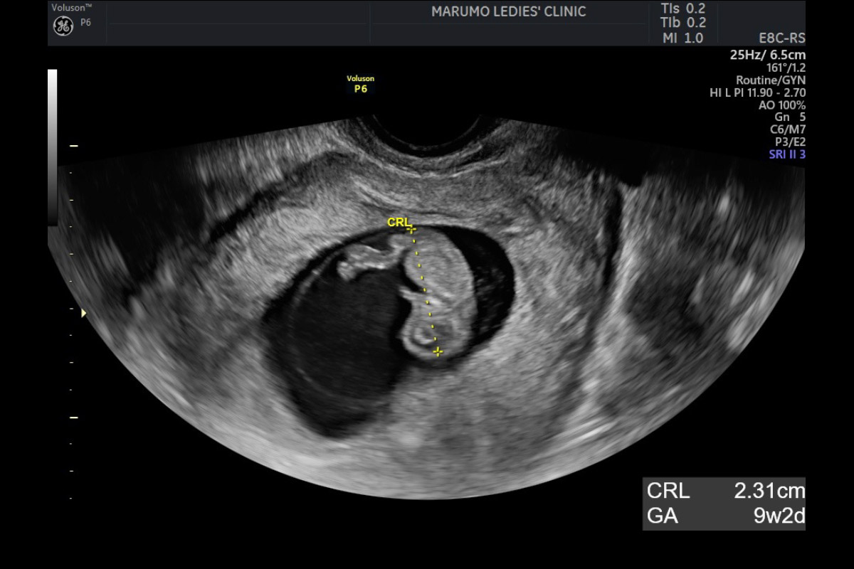 医師監修 産科医がビジュアルで解説します！「超音波写真 エコー写真 の見方」ガイドたまひよ