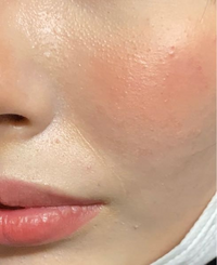 ほうれい線あたりの赤ニキビを治したいです ´；ω；｀-- Yahoo!知恵袋