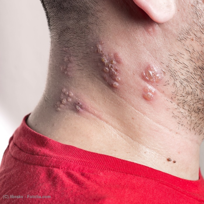 帯状疱疹について - 医療法人清幸会 三原城町病院